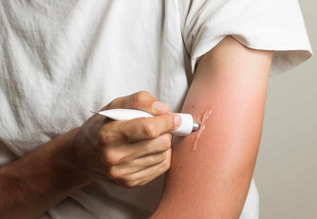 Bị cháy nắng phải làm sao