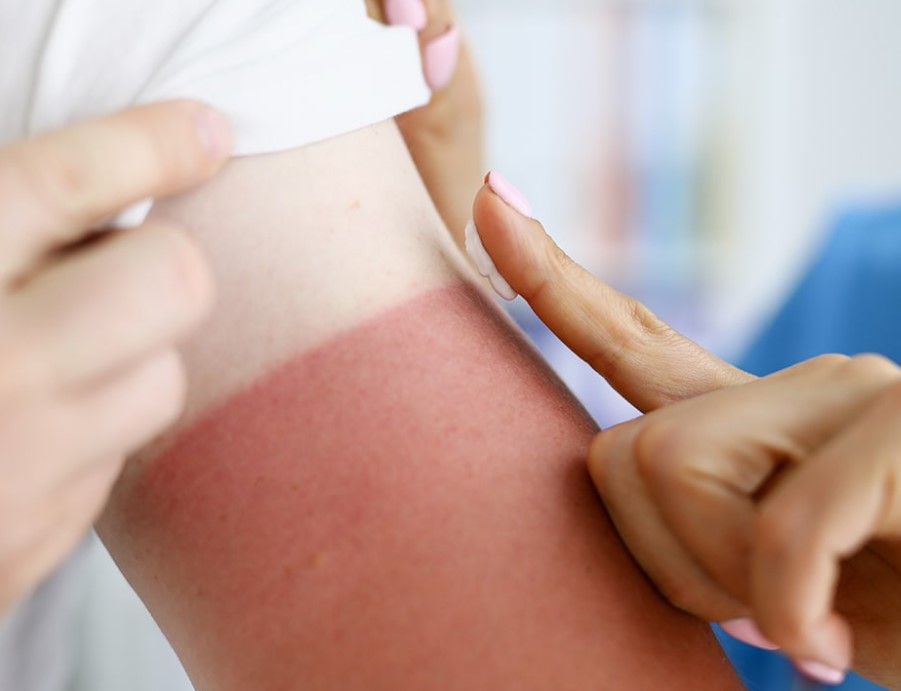 Da bị cháy nắng phải làm sao